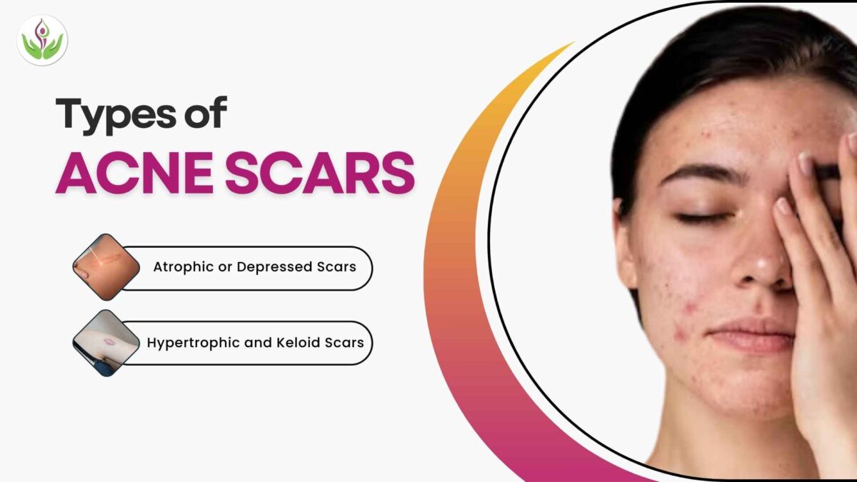 Types of Acne Scars and Acne Scar Treatment in Delhi