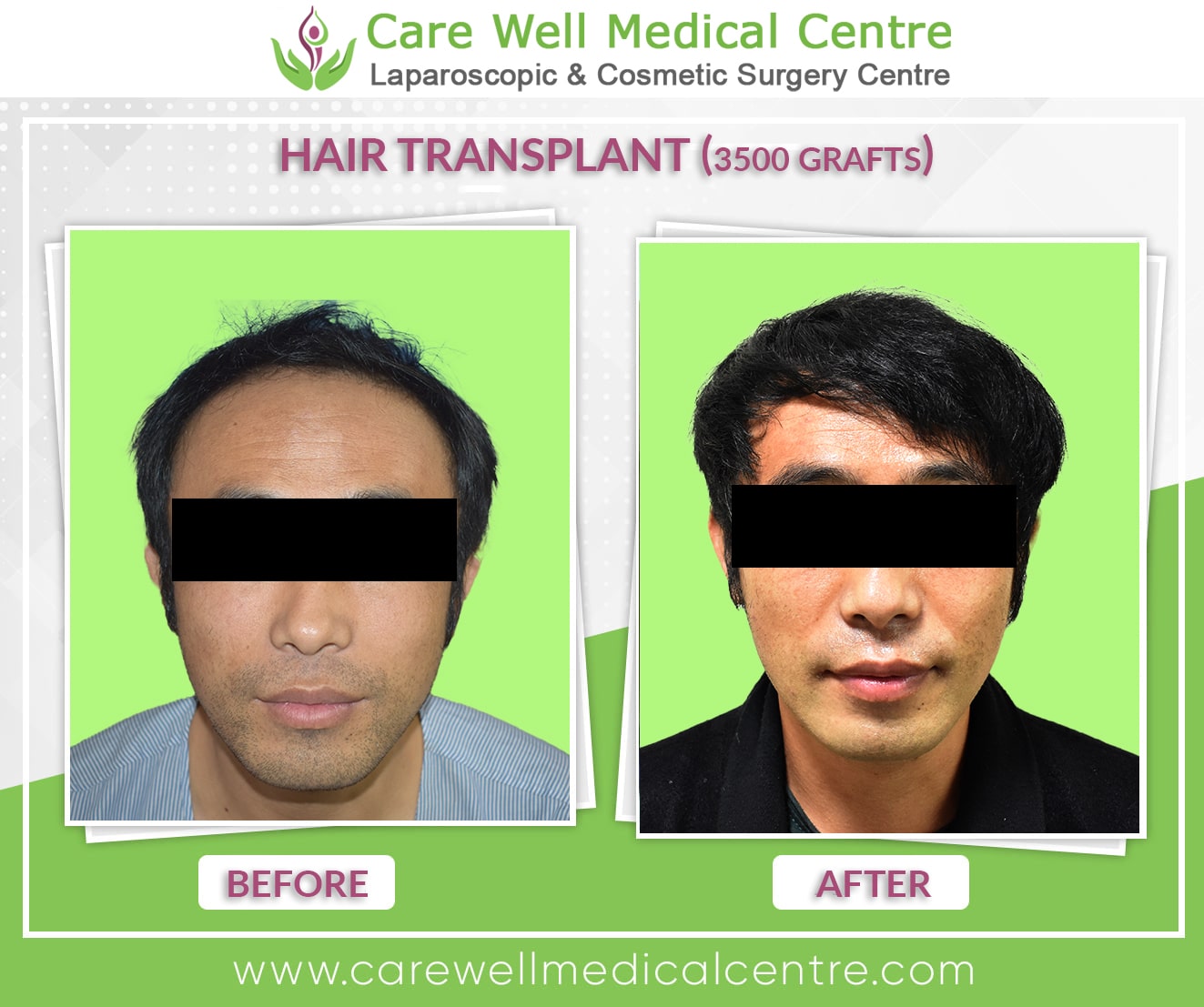 hair transplant in Gurgaon before and after result