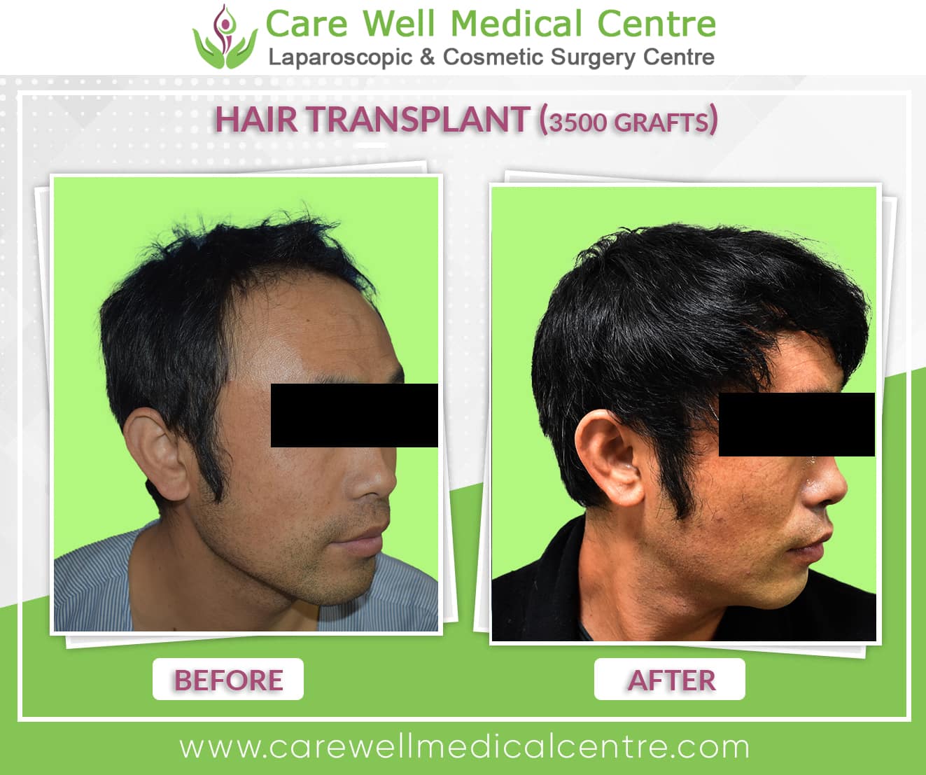 hair transplant in Gurgaon before and after result