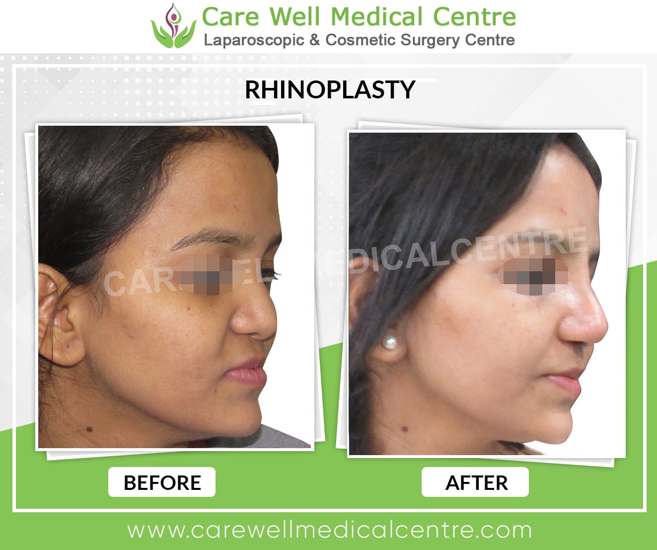 Deviated Nasal Septum Correction in Delhi Before and after Result