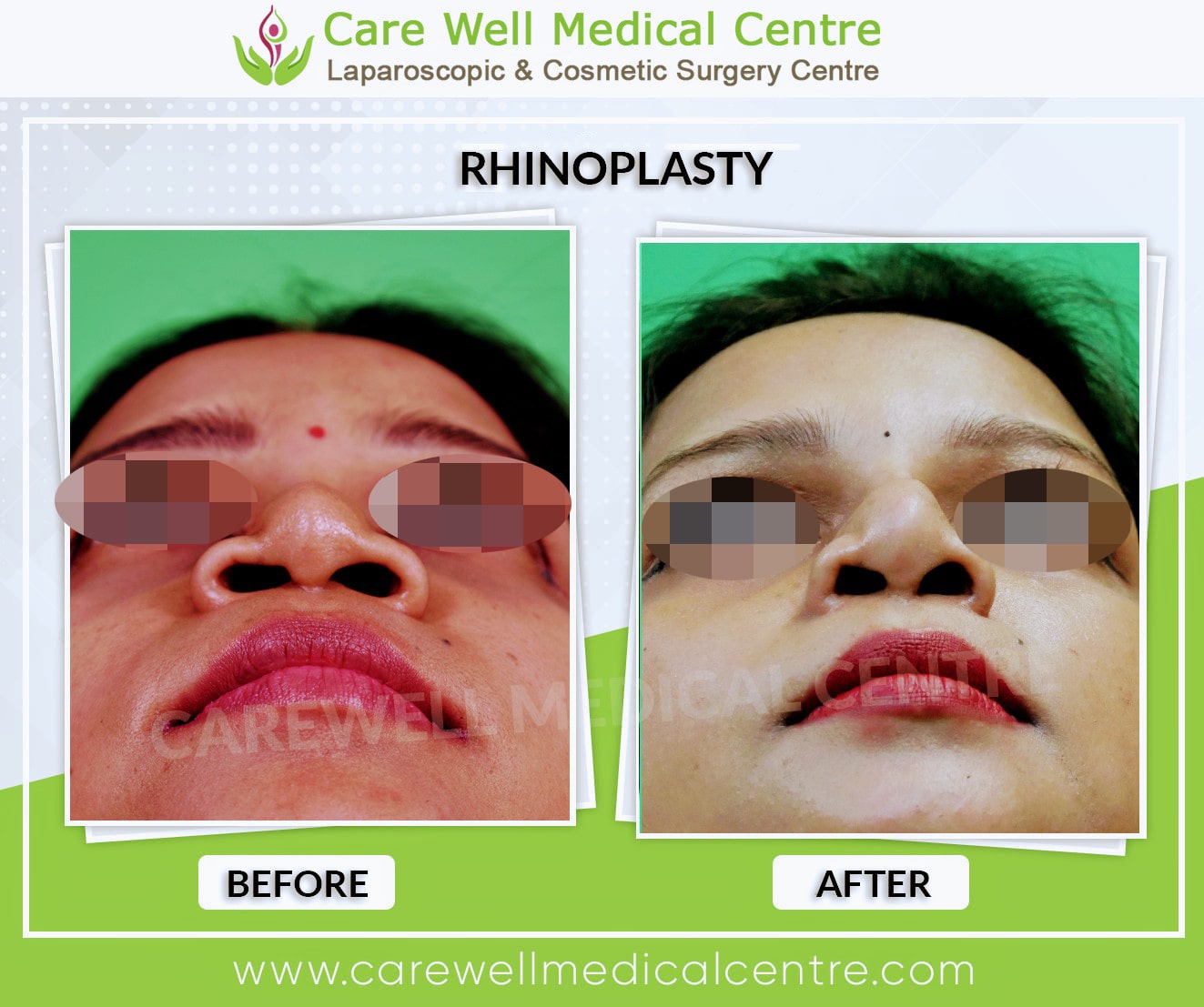 Deviated Nasal Septum Correction in Delhi Before and after Results