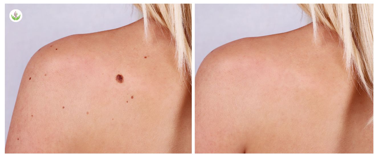 birthmark removal before and after result photo