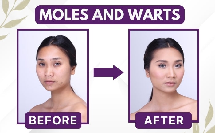 Moles and warts treatment before and after result