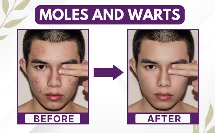 Moles and warts treatment before and after result in Delhi