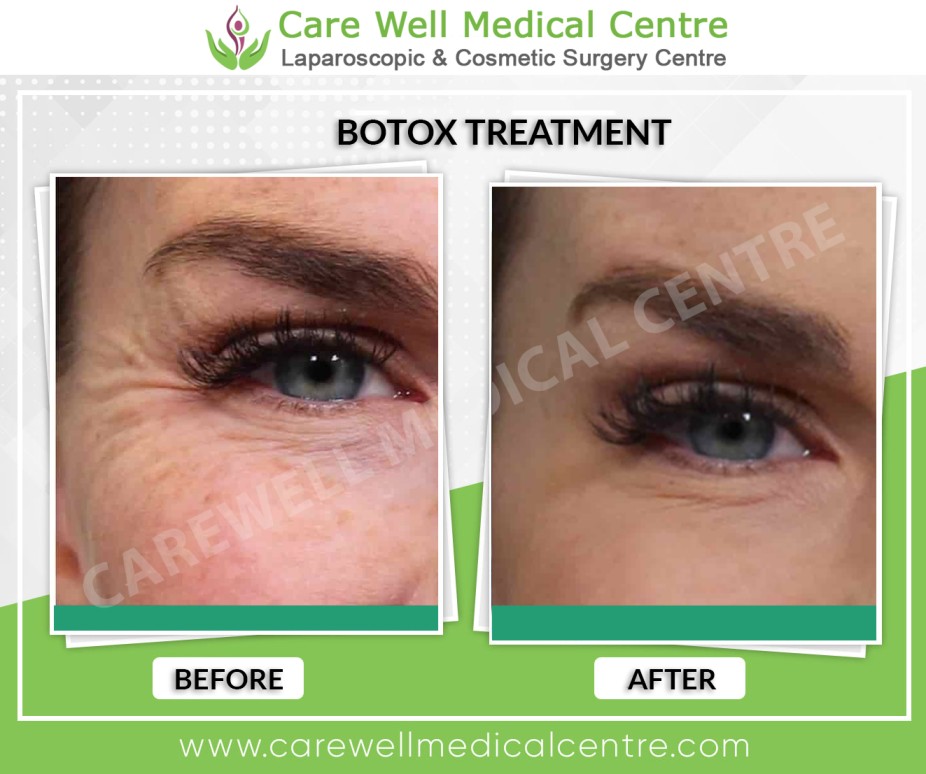 botox eye fillers results