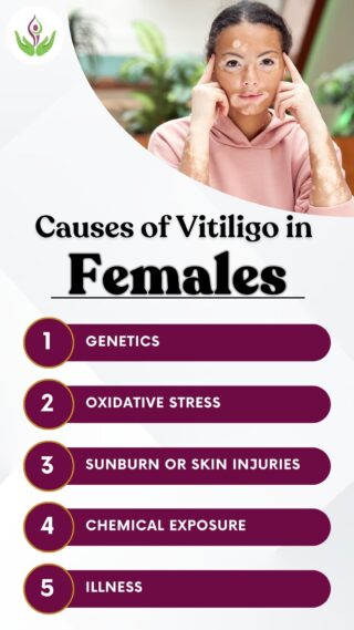 Causes of Vitiligo in Female