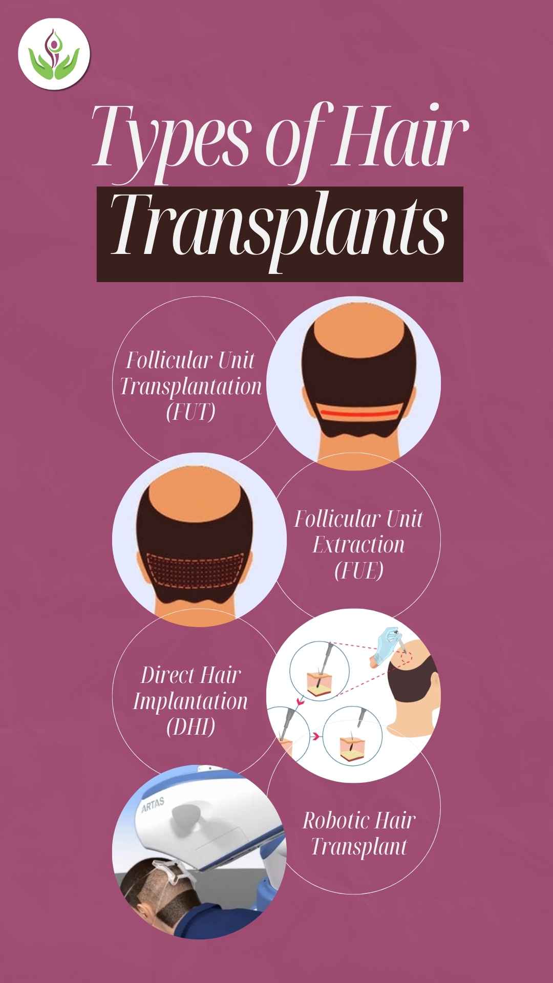 Types of Hair Transplants