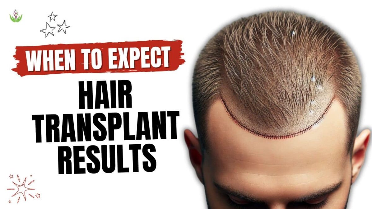 When-Will-Hair-Transplant-Results-Show-min-1200x675.jpg