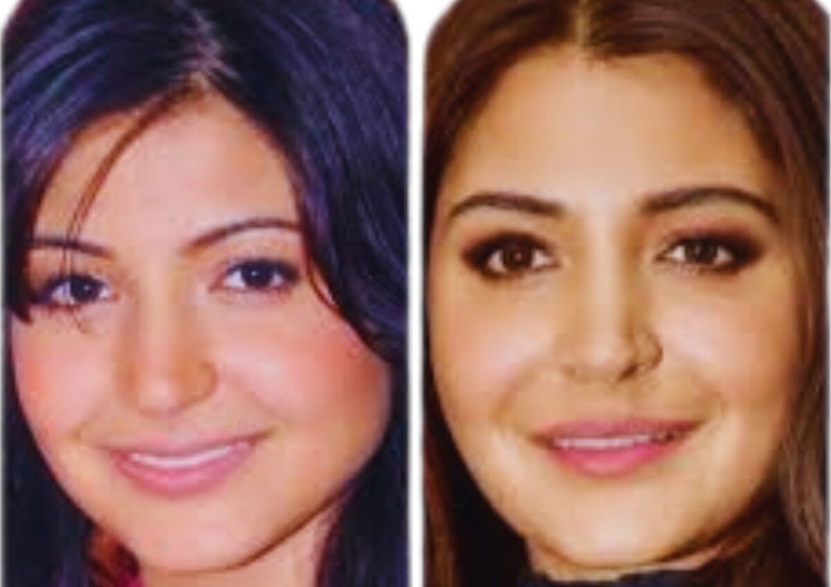 Anushka Sharma's before and after transformation reflecting trends in Bollywood celebrities and plastic surgery.