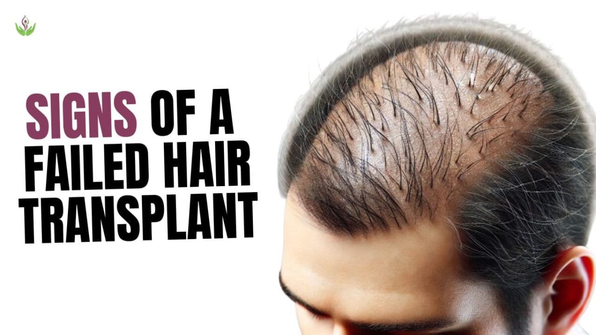 Signs of a Failed Hair Transplant