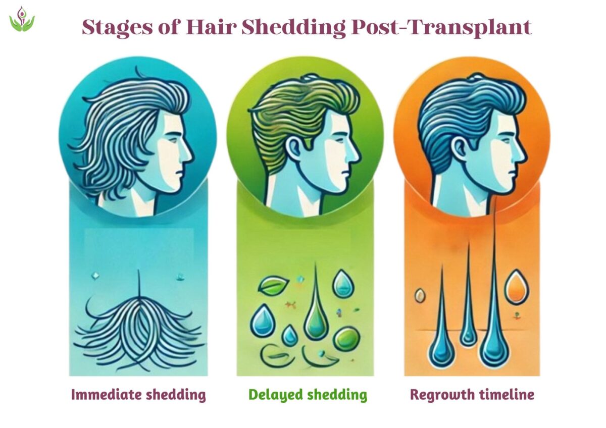 Hair shedding stages after transplant