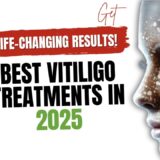 Best vitiligo treatments in 2025 with advanced solutions.