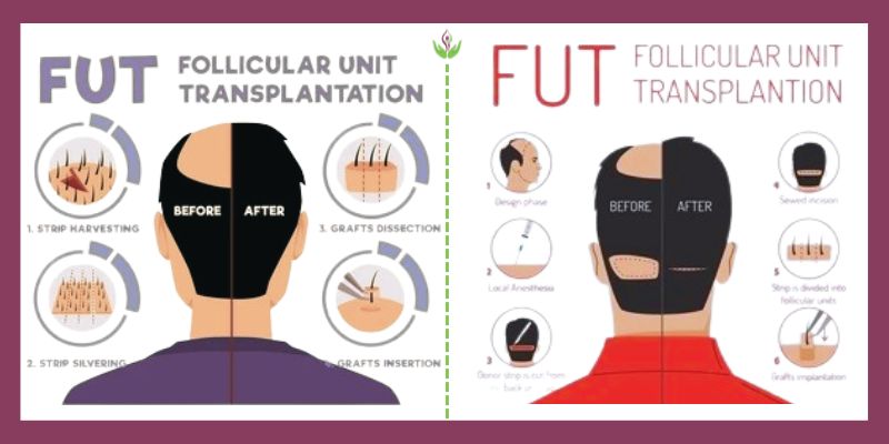 Comparison of FUT vs FUE hair transplant techniques and their impact on the hair transplant cost breakdown in India