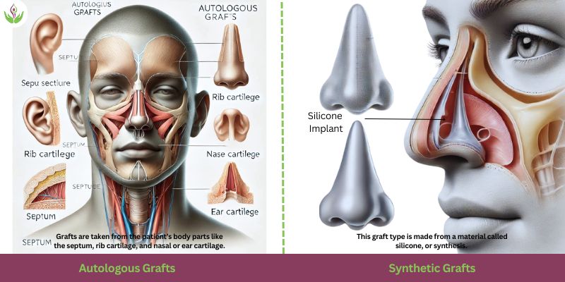 Rhinoplasty Grafts: Autologous and Synthetic Types in Best Rhinoplasty Techniques