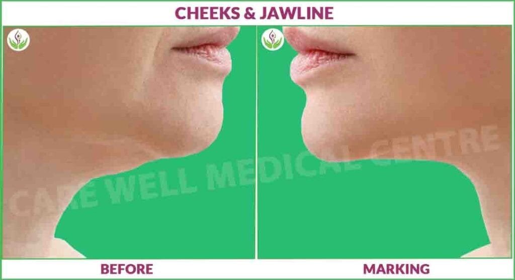 Cheek & jawline slimming treatment in Delhi before and after results