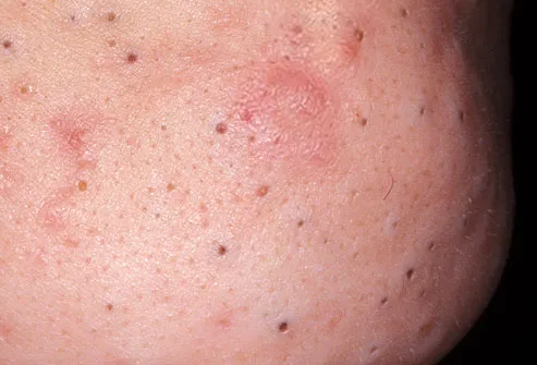 Blackheads