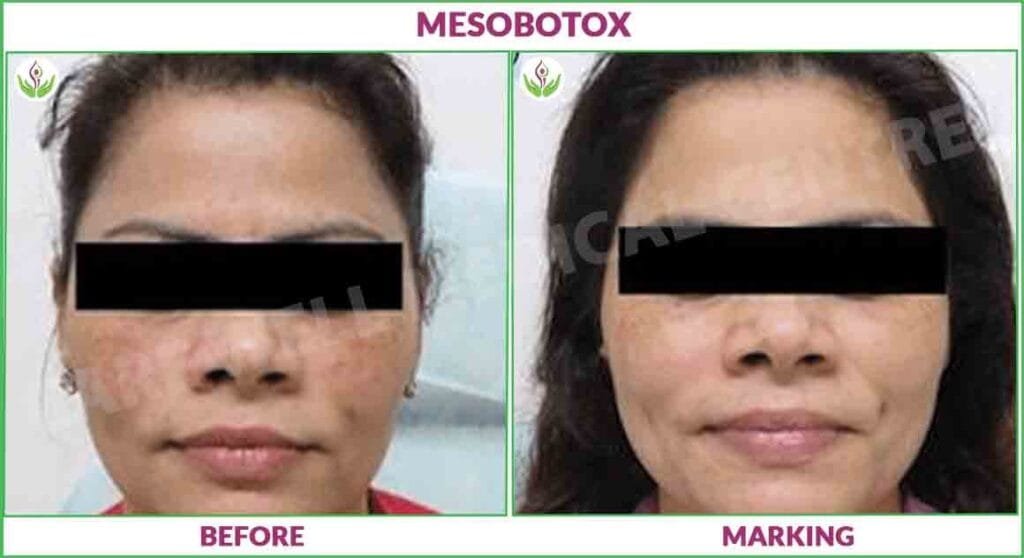 Before and After Results of Mesobotox Treatment in Delhi