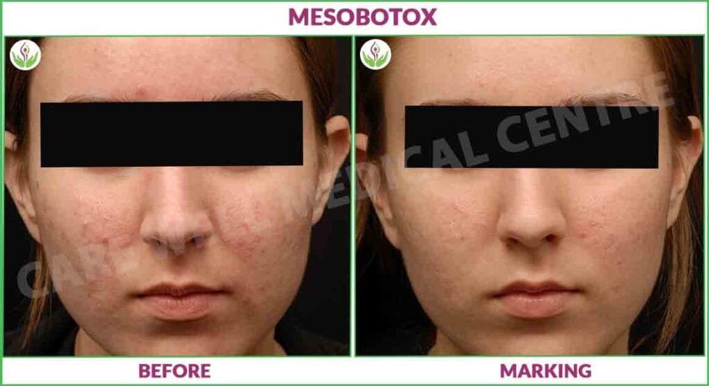 Result of Before and After Mesobotox Treatment in Delhi for Glowing Skin