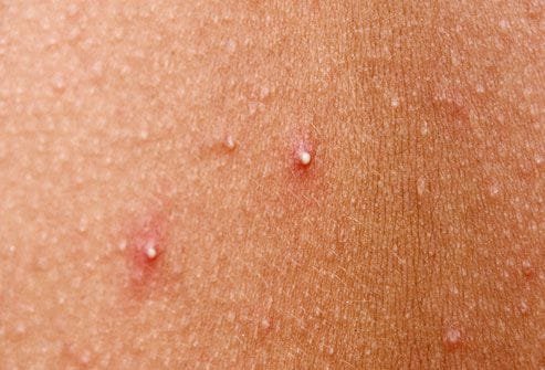 Whiteheads (closed comedones)