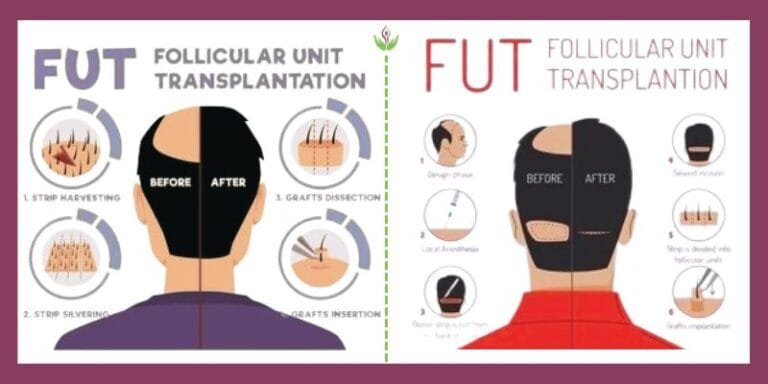 Comparison of FUT vs. FUE hair transplant techniques and their impact on cost
