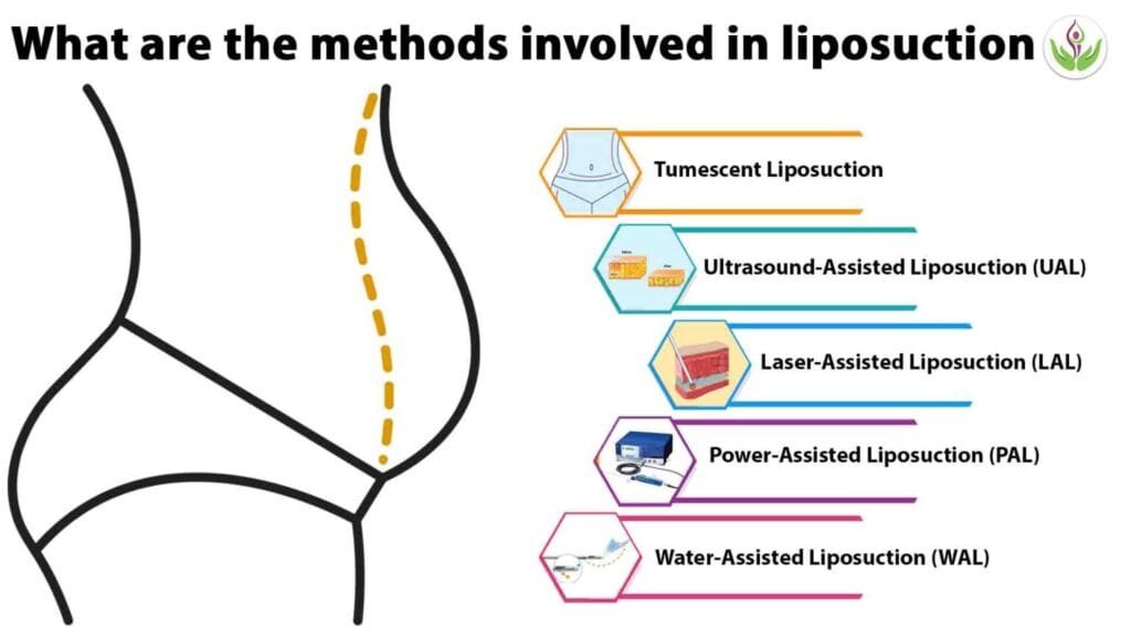 methods involved in liposuction