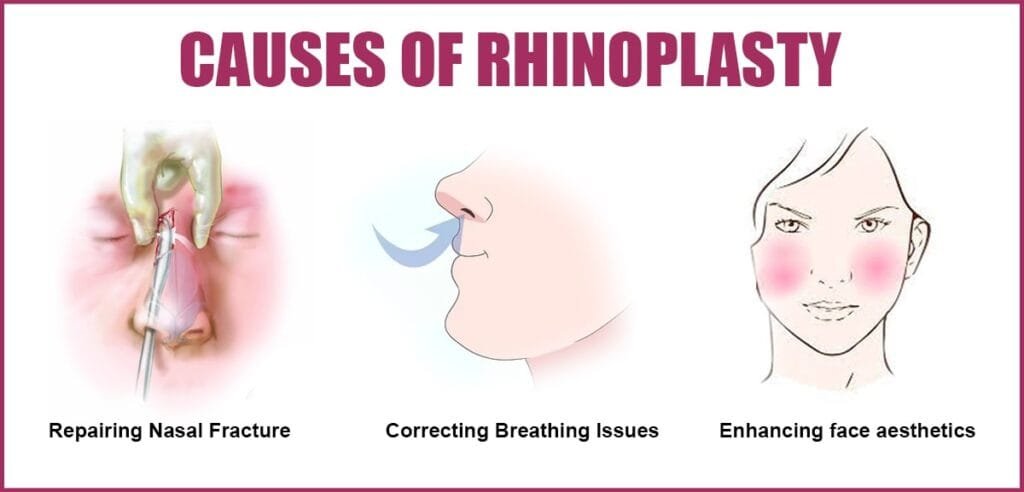 Causes of Rhinoplasty