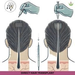 Direct Hair Transplant technique and cost breakdown in India.