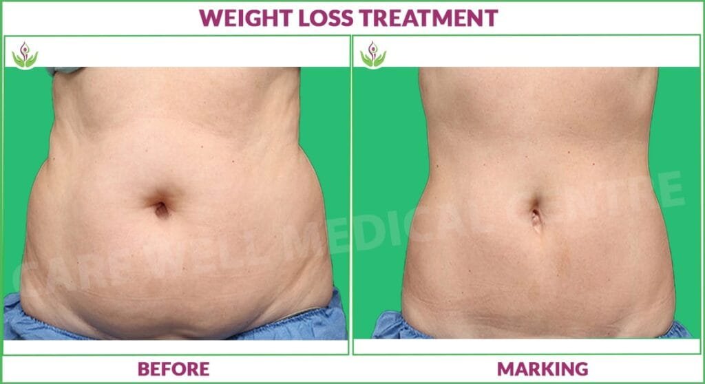 Weight Loss Treatment in Delhi – Before and After Results